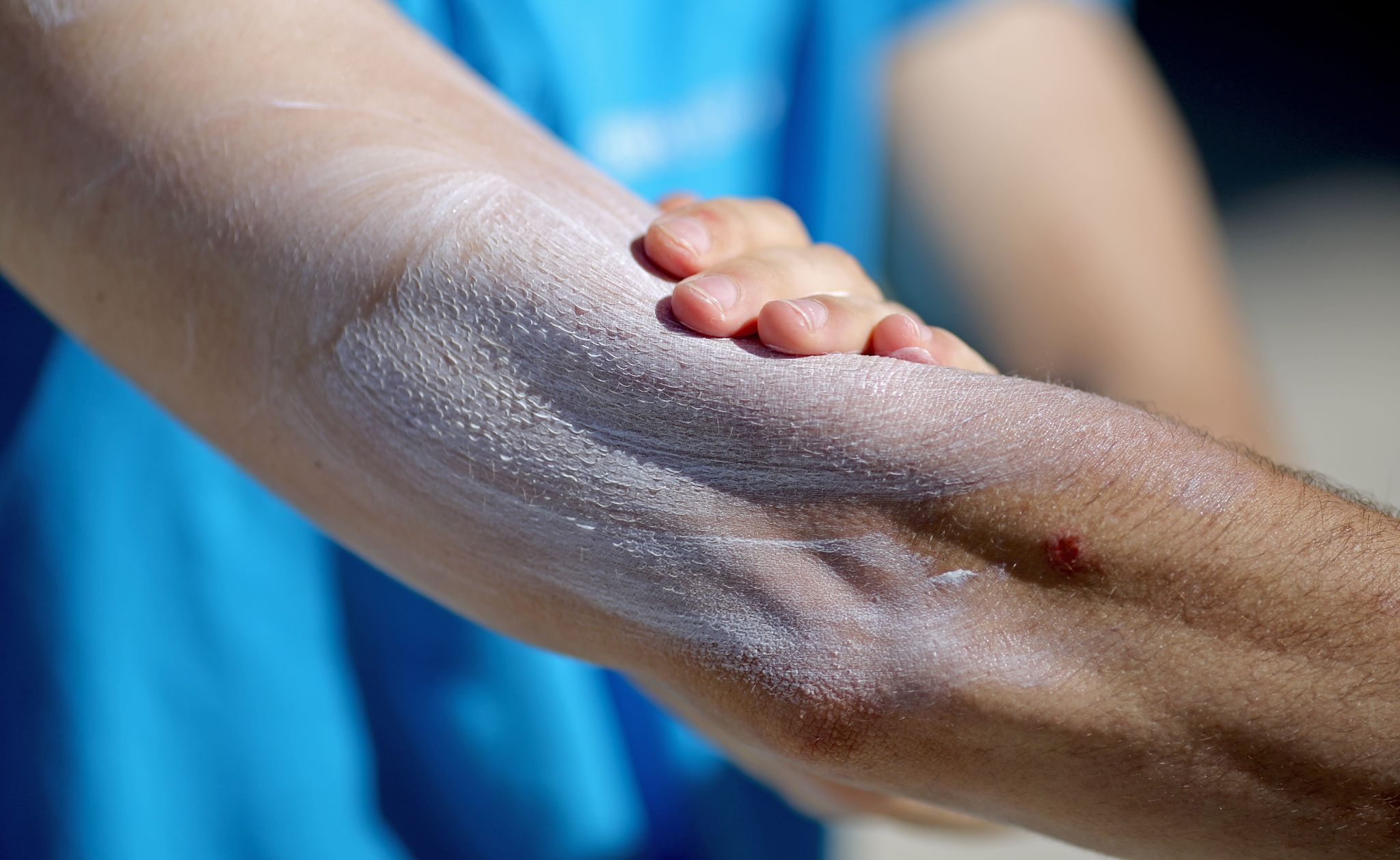 Umfrage: Sonnenschutz ist wichtig, eincremen lästig