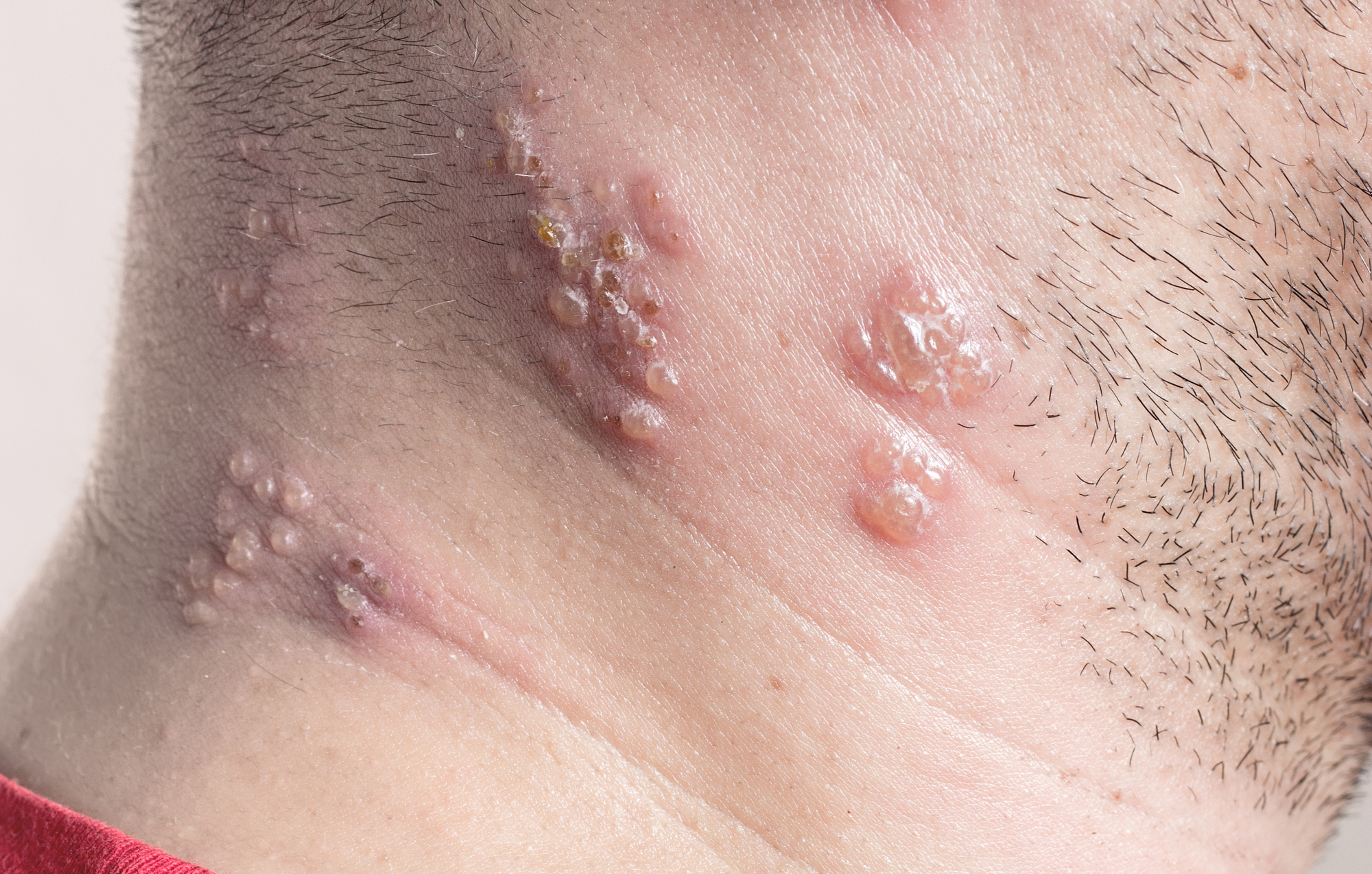 121 Fälle: Gürtelrose nach Corona-Impfung