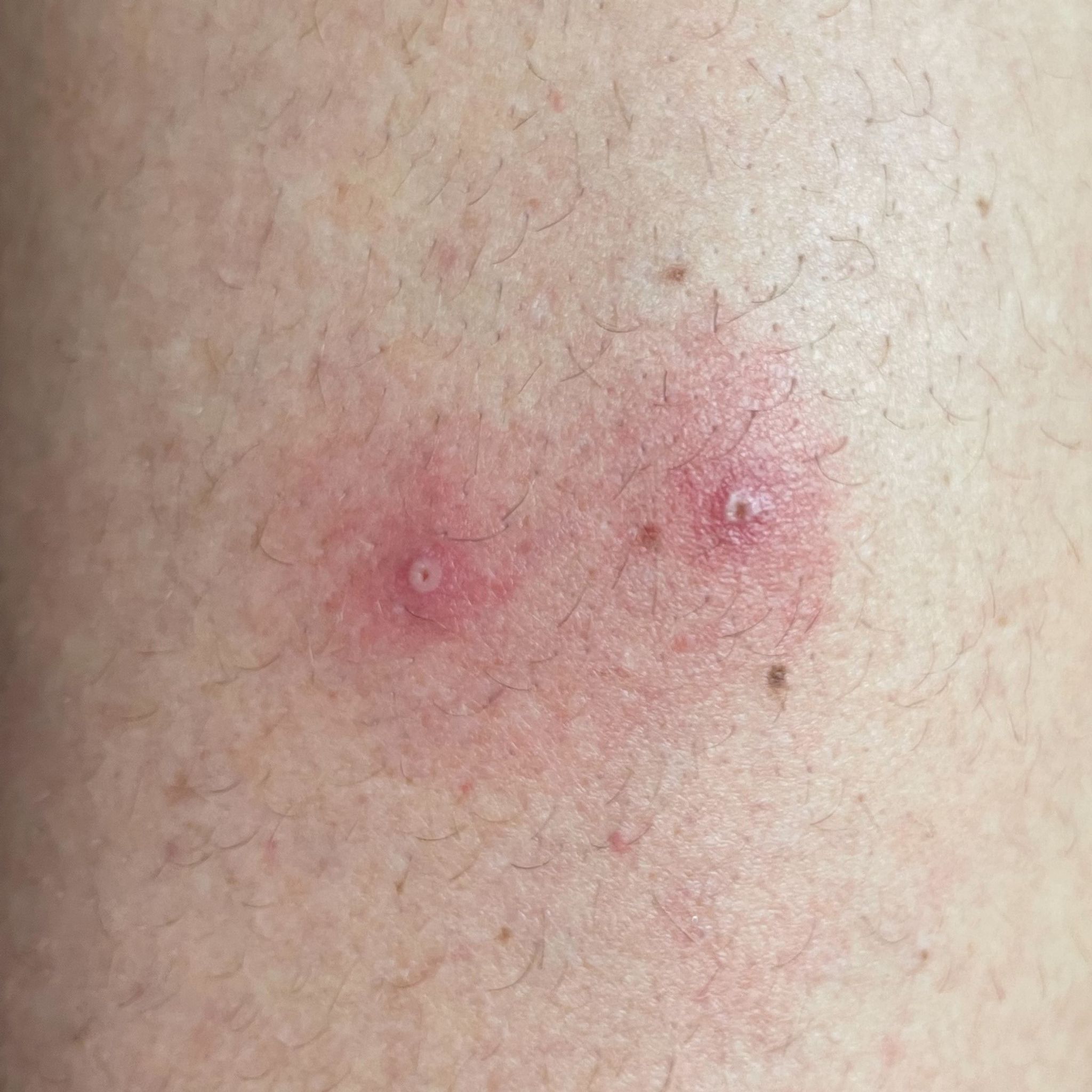 WHO-Alarm wegen Affenpocken? Experten beraten in Genf