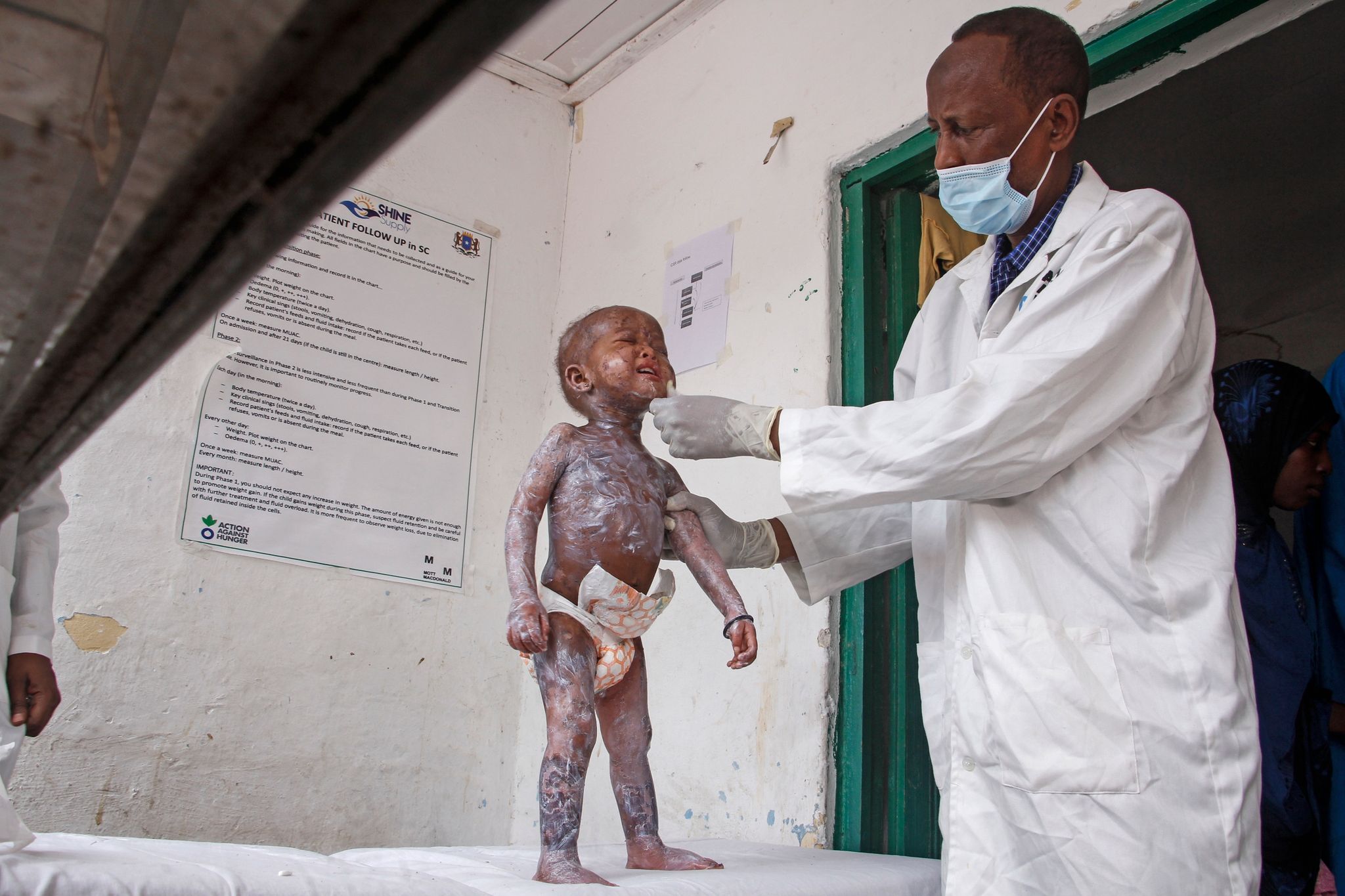 Jede Minute ist ein weiteres Kind schwer mangelernährt
