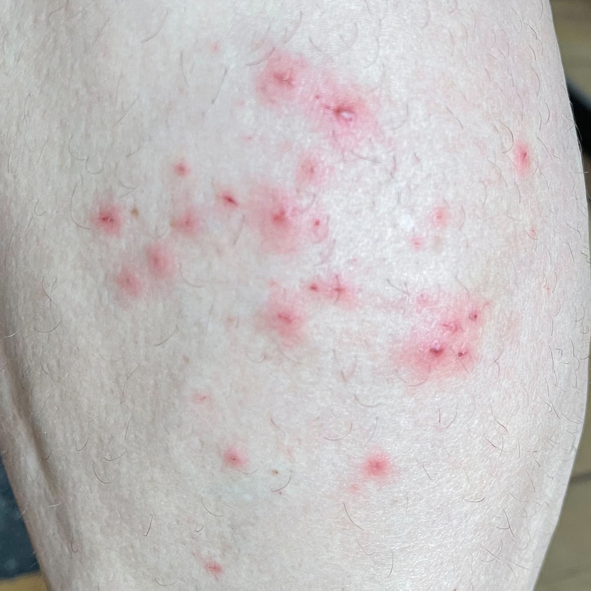 Erster Patient mit Affenpocken-Virus in Deutschland genesen