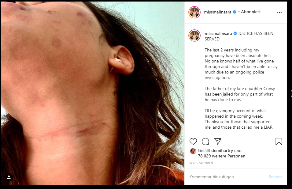 „Love Island“-Star Malin Andersson: Zeigt Bilder von ihrer Misshandlung durch Freund