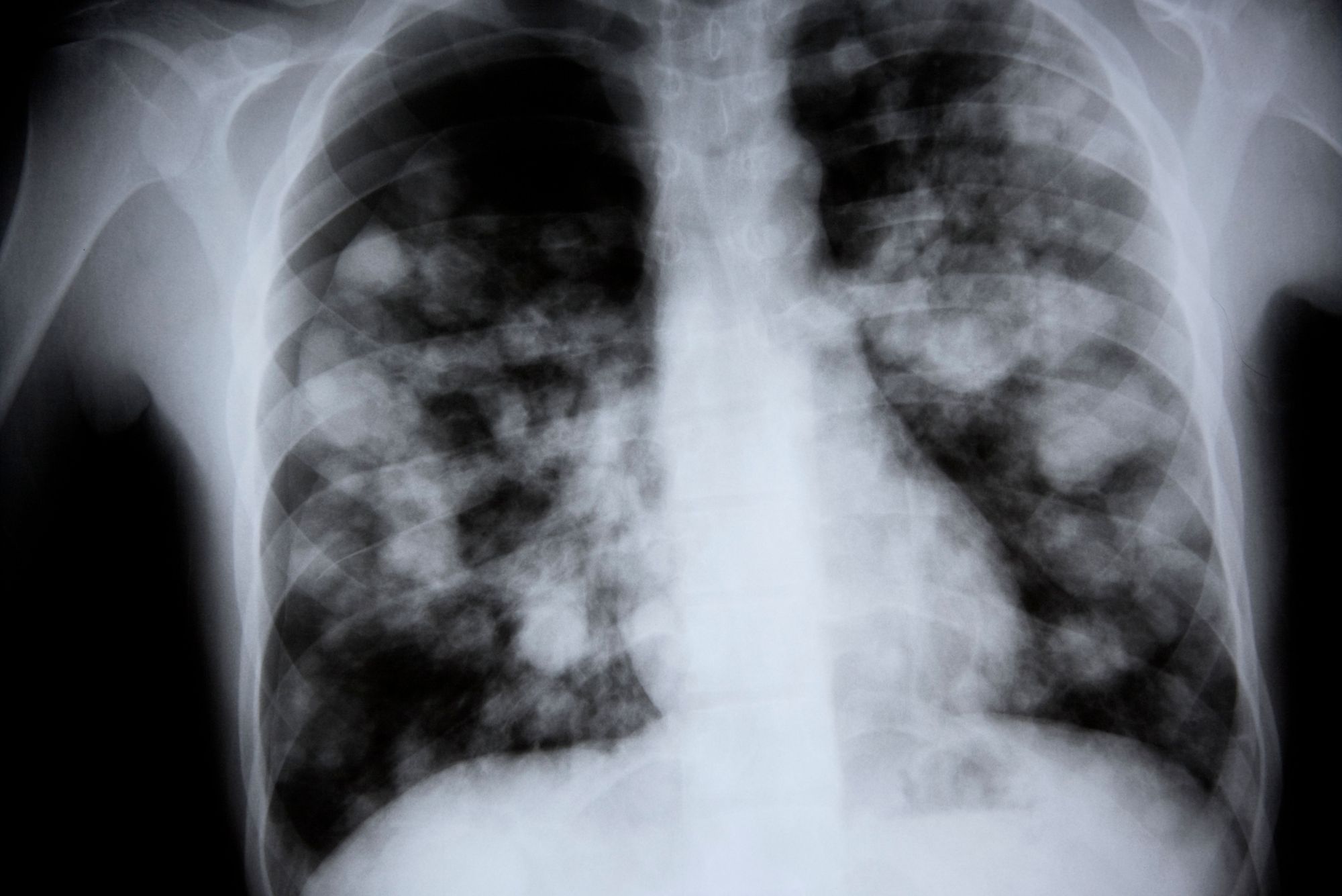 Vogel-Grippe: Junge (11) stirbt an Virus