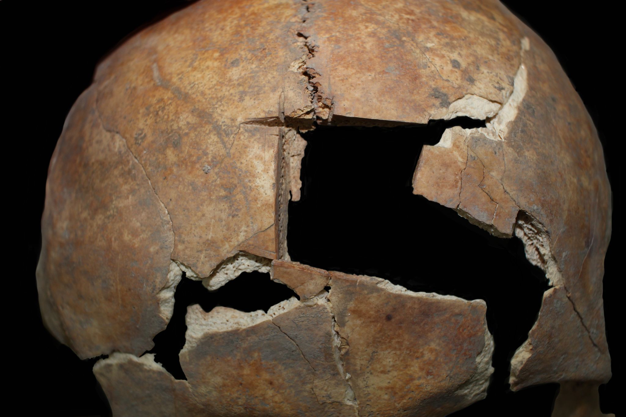 Mann vor etwa 3500 Jahren an Schädel operiert