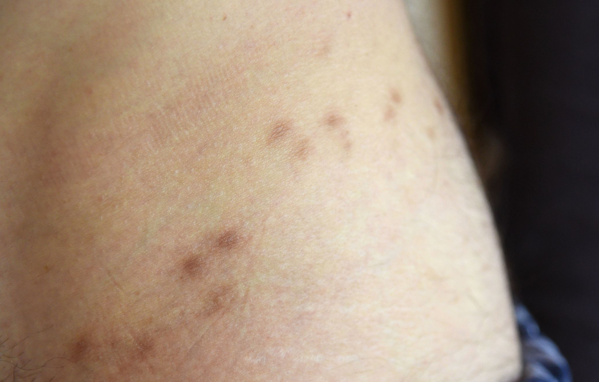 40 Prozent Rohingya in Lagern leiden an Krätze