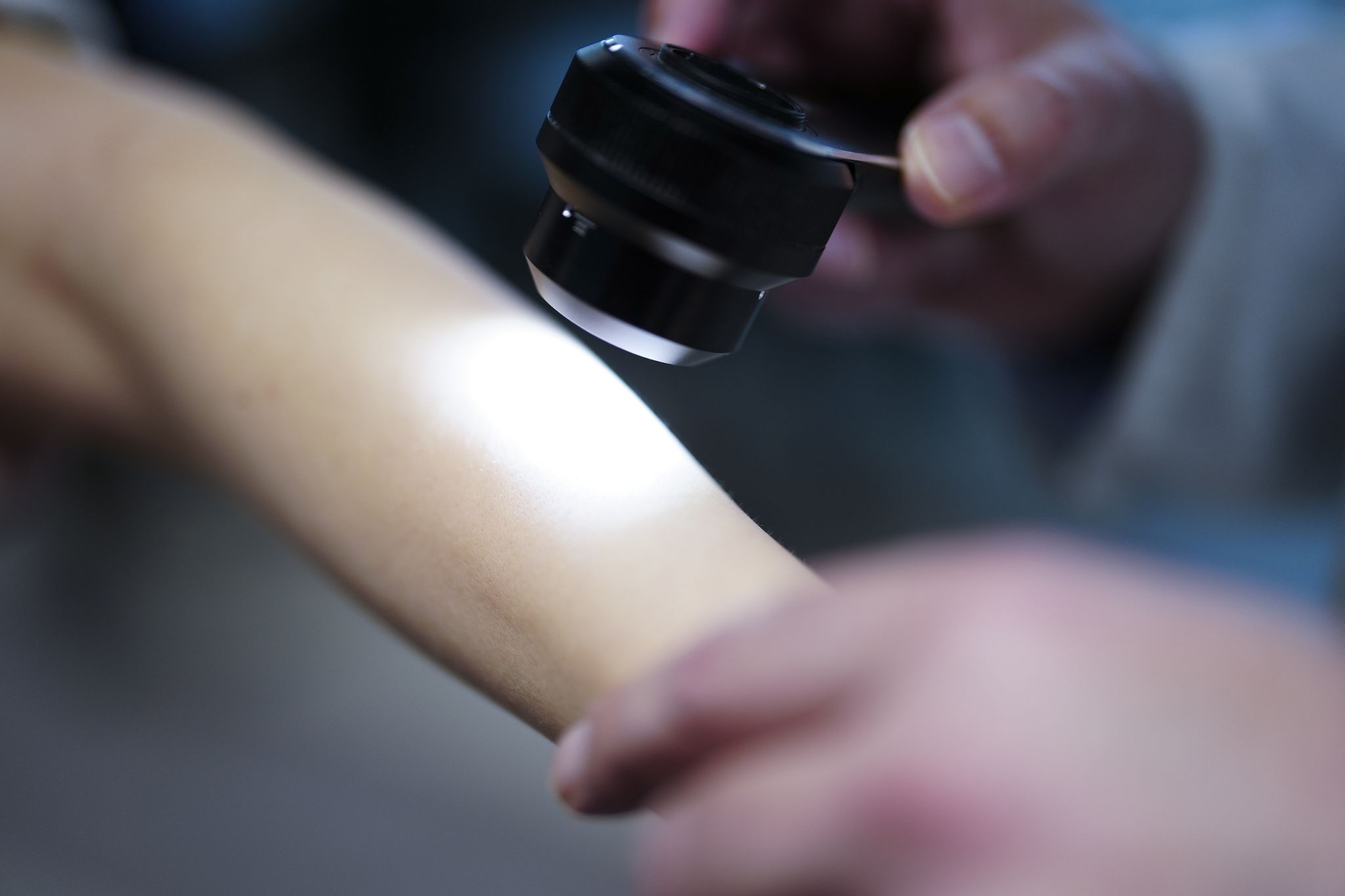 Verband fordert staatlich organisiertes Hautkrebs-Screening