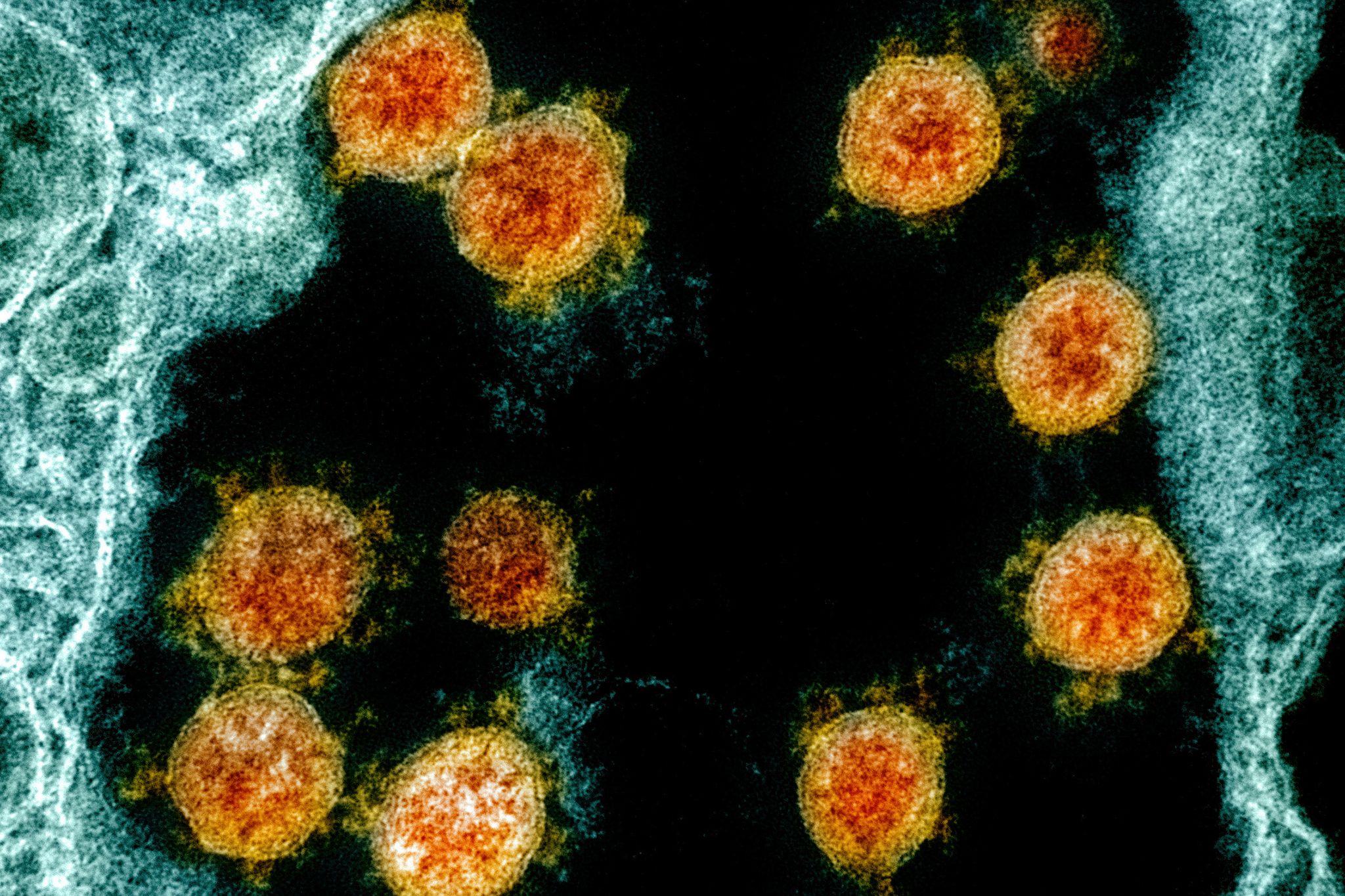 Extrem lange Coronainfektion: Forscher warnen vor gefährlicheren Varianten