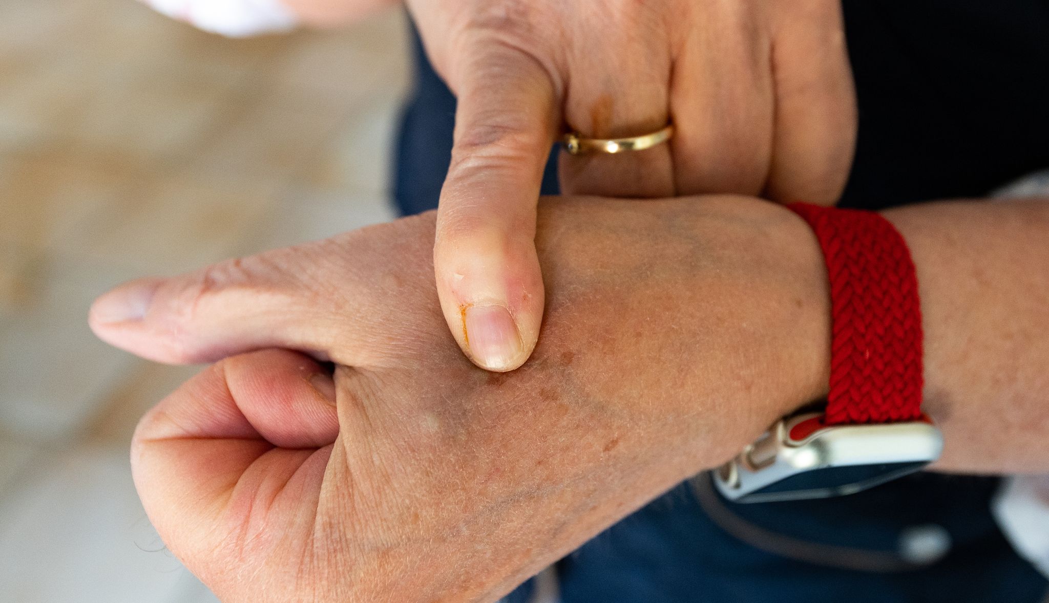 Umfrage: Mehr als ein Drittel ist offen für Chip-Implantate