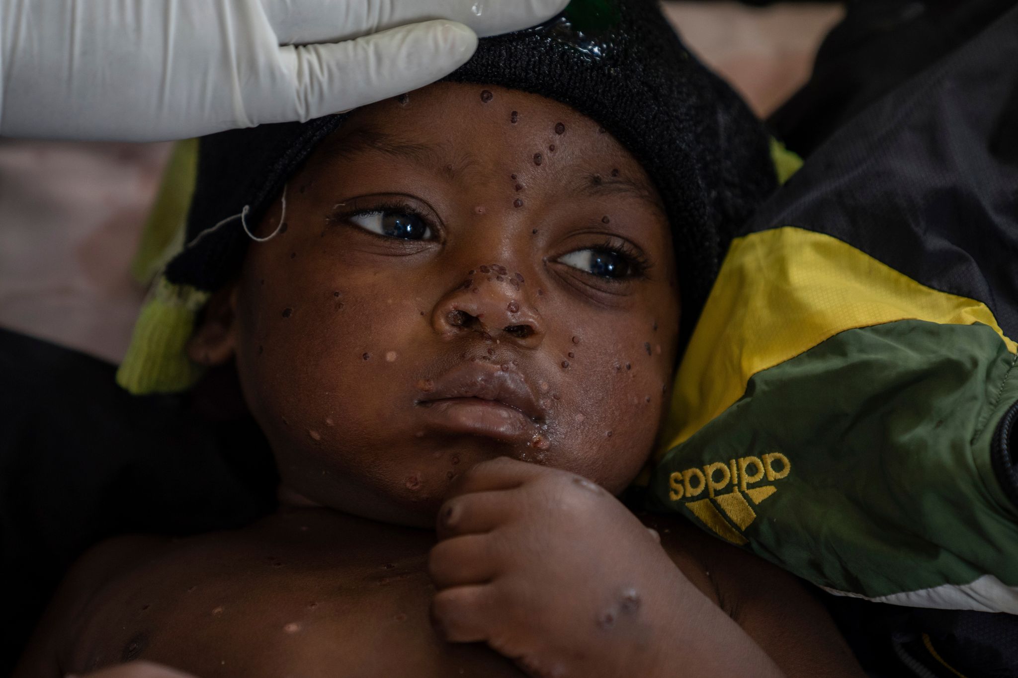 Verbreitung von Mpox in Afrika nimmt zu