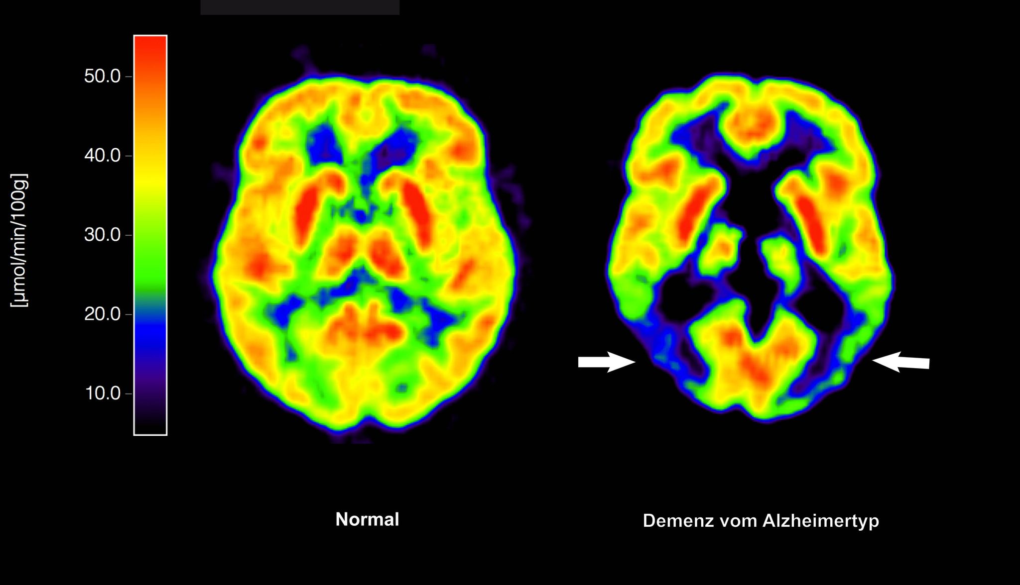 Neue Alzheimer-Therapie zugelassen: Hoffnung für Betroffene