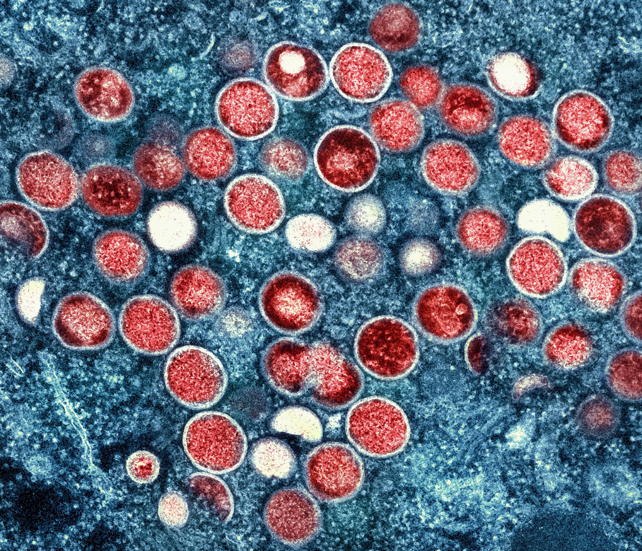 Deutschland: Anstieg von Mpox-Infektionen, RKI bleibt gelassen