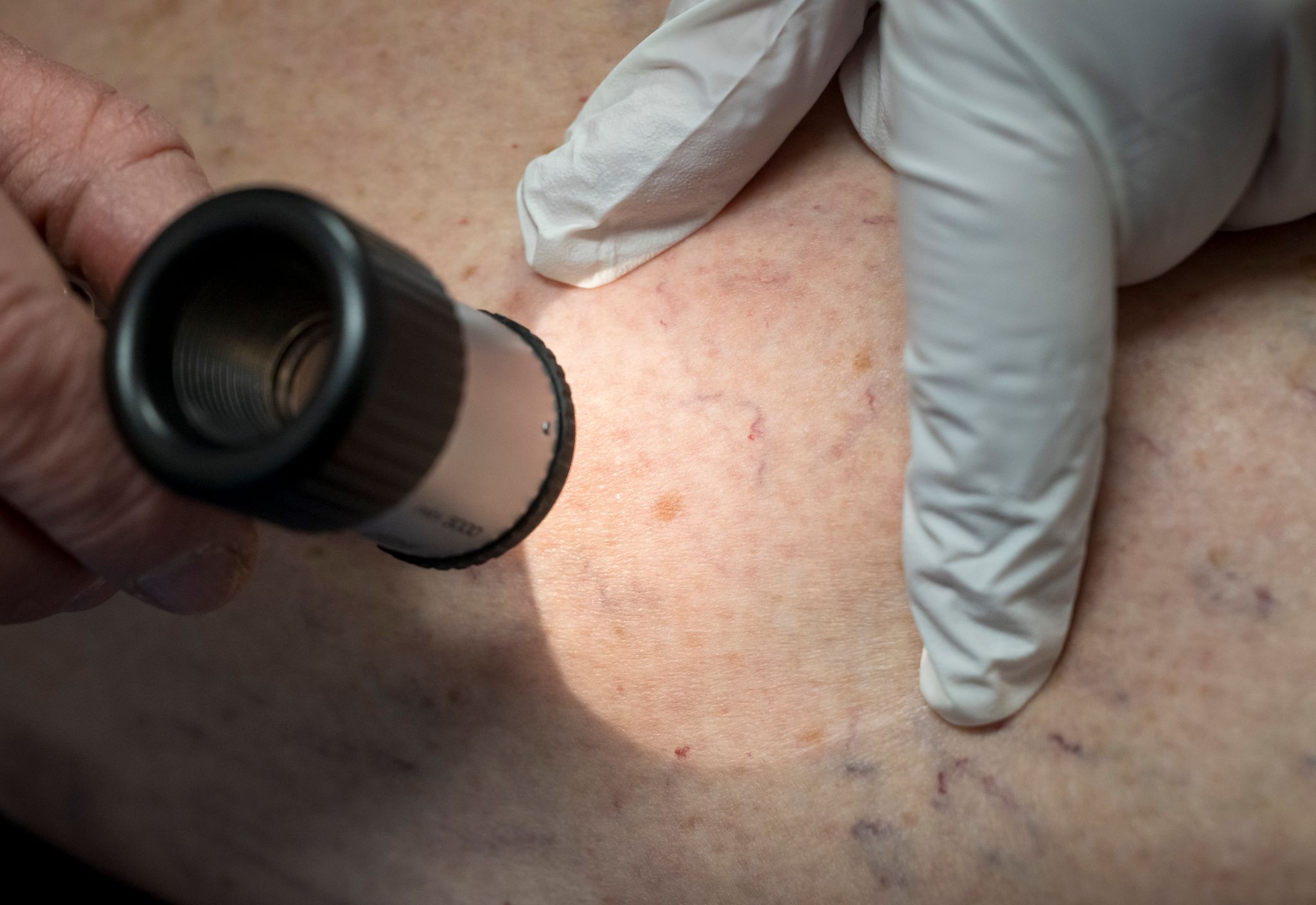 Wesentlich mehr in Kliniken behandelte Hautkrebsfälle