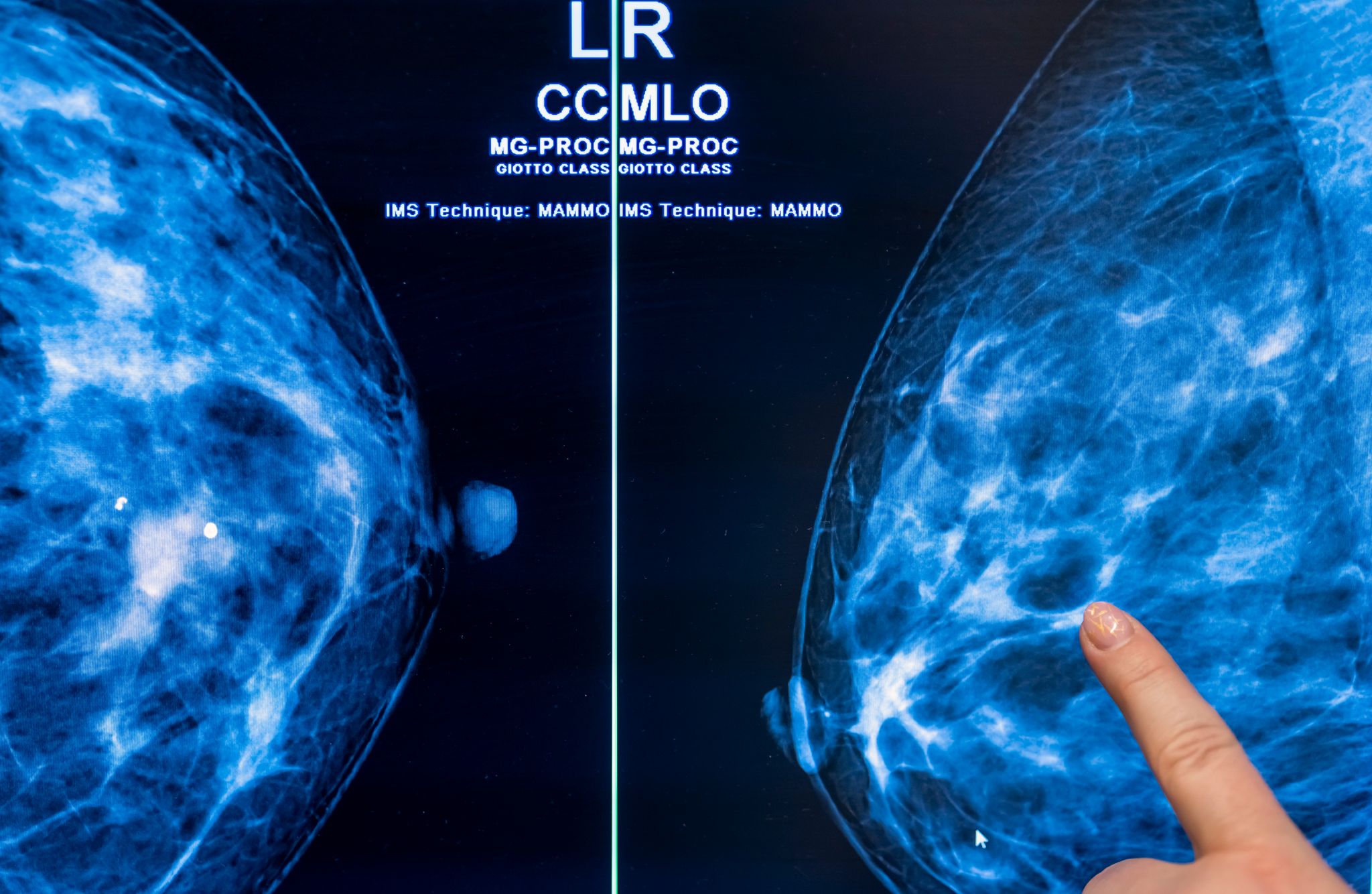 Mammografie-Screening senkt Brustkrebs-Sterblichkeit