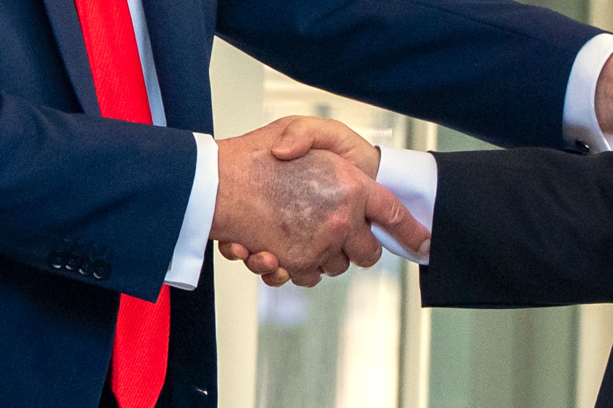Trump erneut mit Bluterguss an der Hand fotografiert