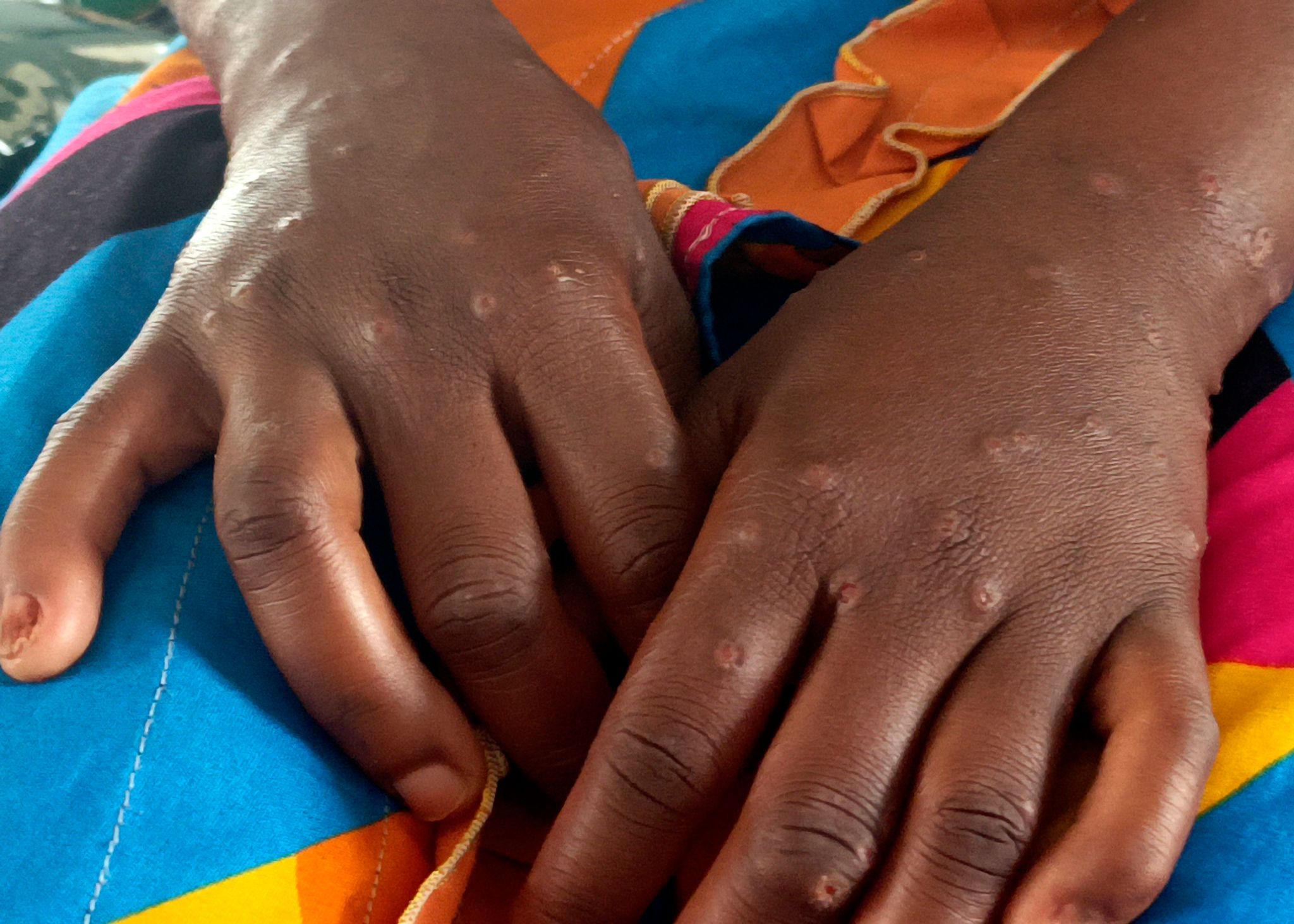 Internationale Notlage wegen Mpox aufgehoben