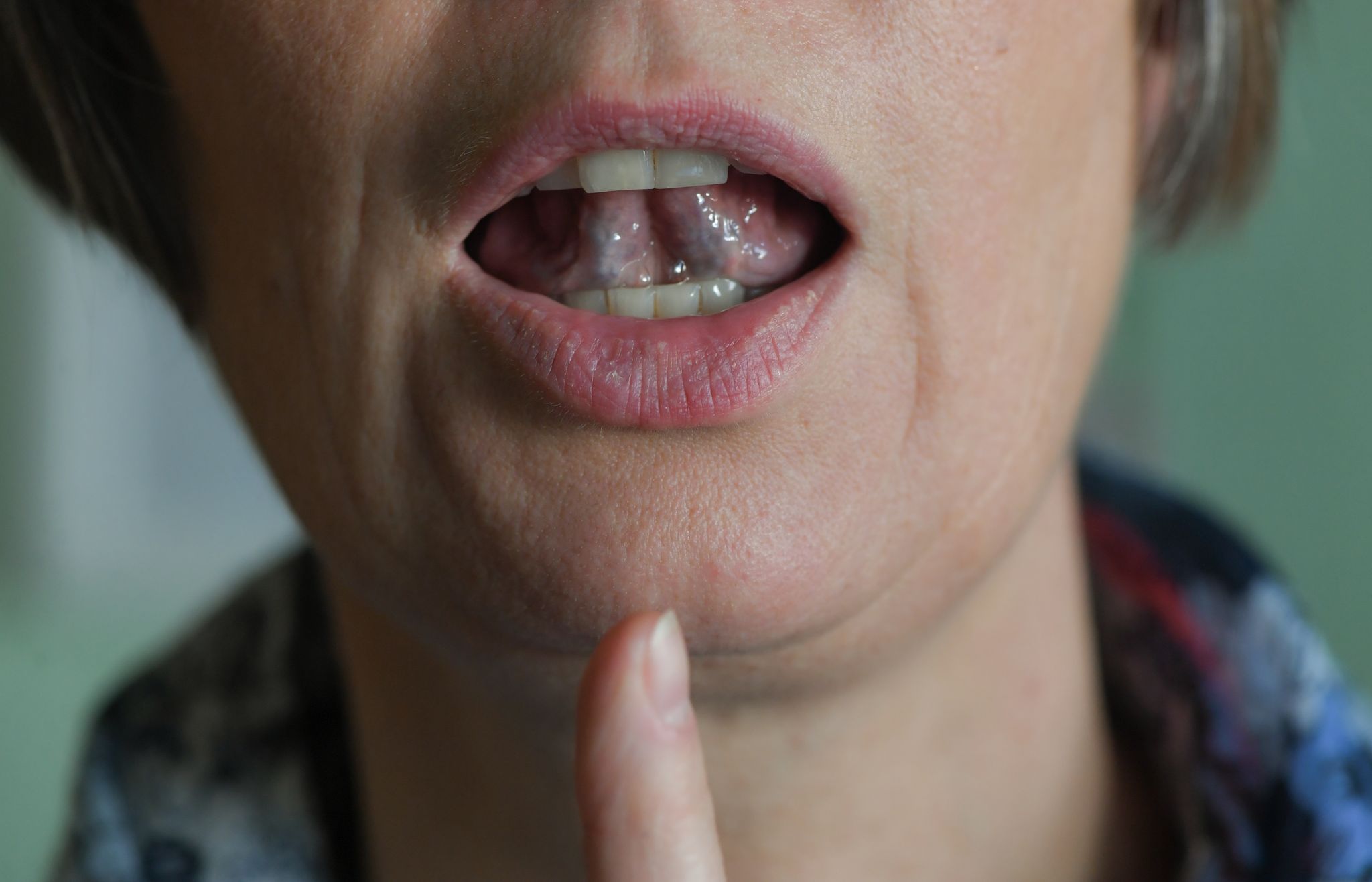 Stottern: Ursachen, Symptome und Therapiemöglichkeiten