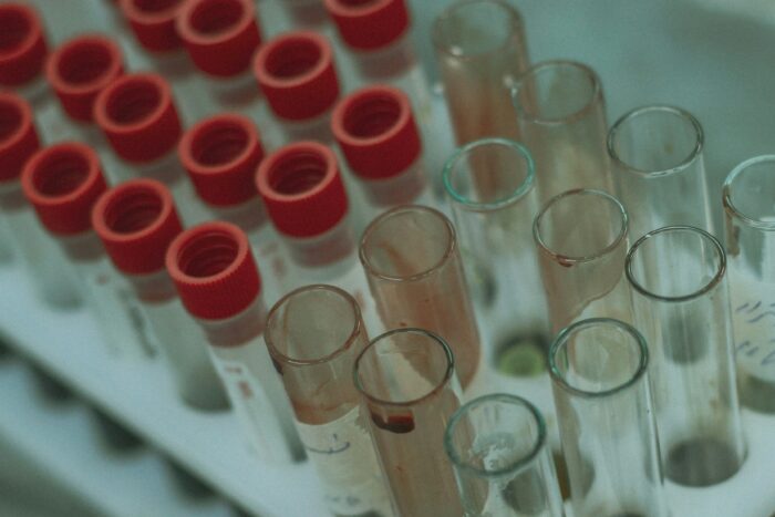 Neuer Bluttest weckt Hoffnung auf Früherkennung bei Bauchspeicheldrüsenkrebs